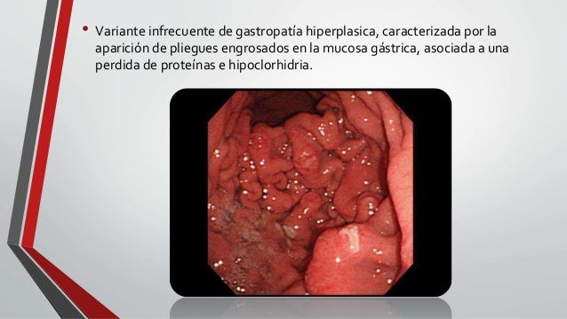 Enfermedad De Menetrier Pdf